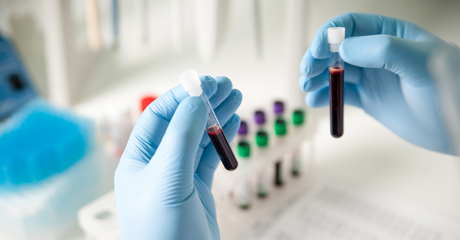 Blood Test for Alzheimer's Disease