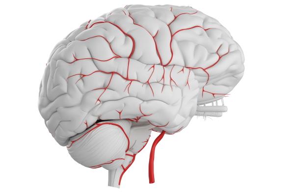 Vascular Dementia Vascular Dementia